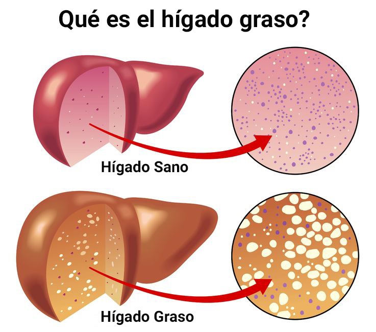 ¿Sufre de hígado graso? - El Opinadero